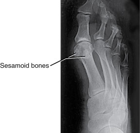 Sezamoidna kost 